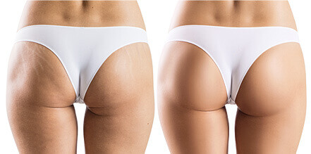 Skinception™ Intensive Stretch Mark Therapy